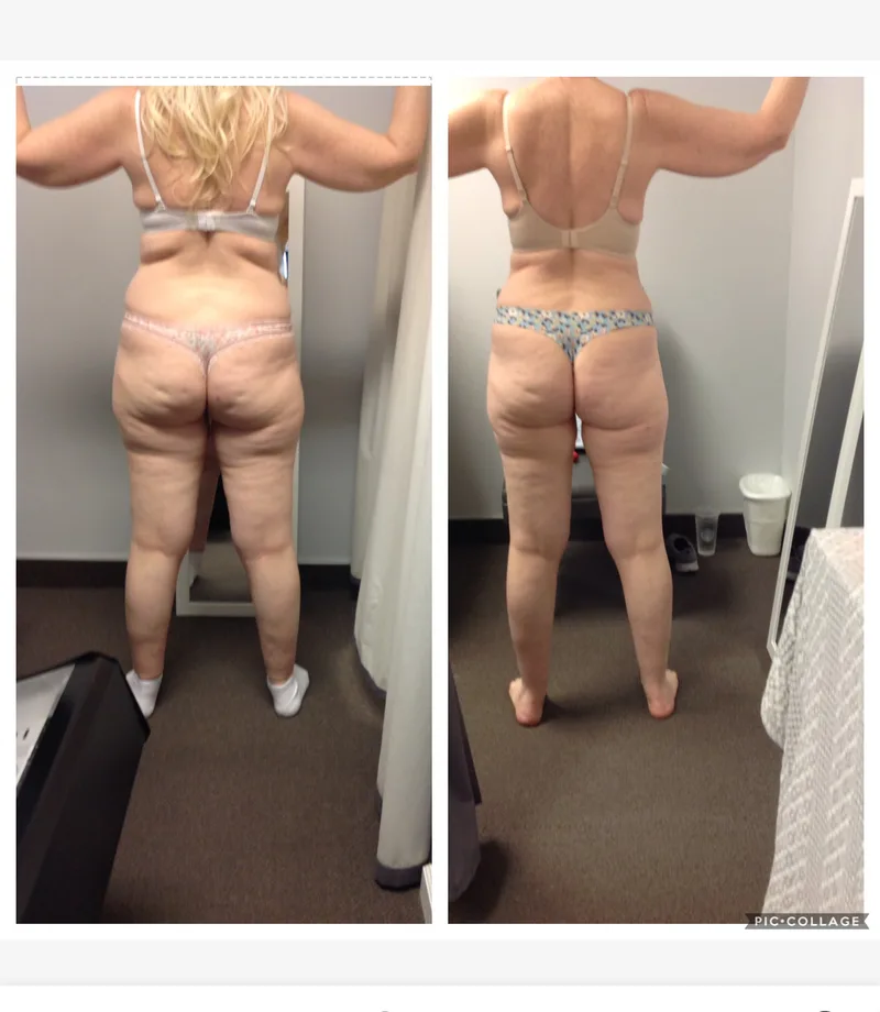 Female client body composition before and after, back view showing reduced width and smoother contour