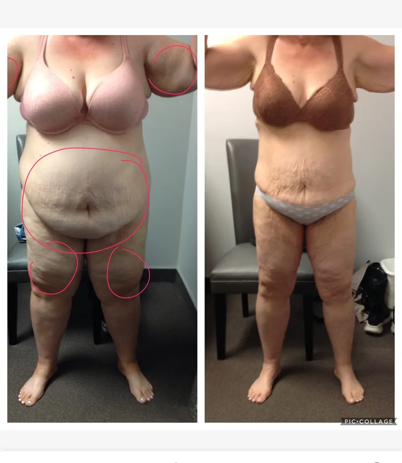 Female client body composition before and after, front view showing reduced waist and improved tone
