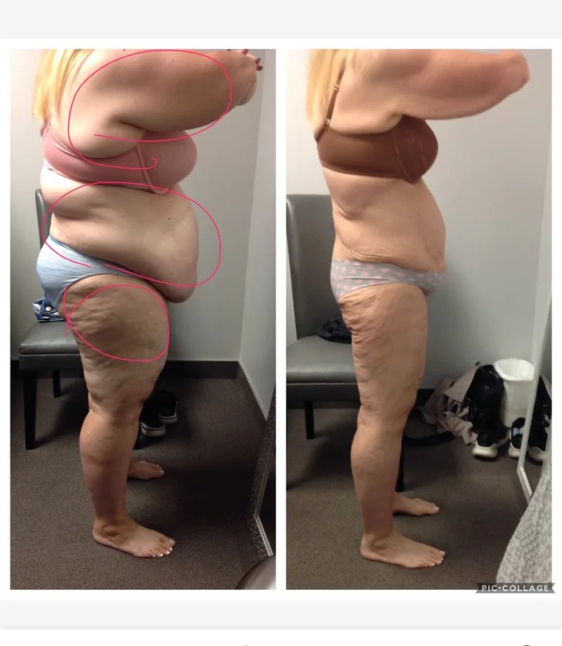 Female client dramatic body composition transformation, side view showing significant fat reduction