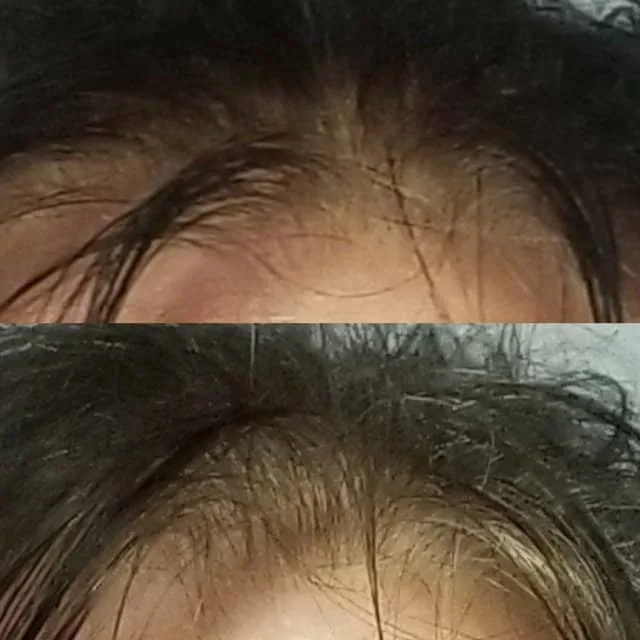 Client hair regrowth before and after, showing fuller hairline and density