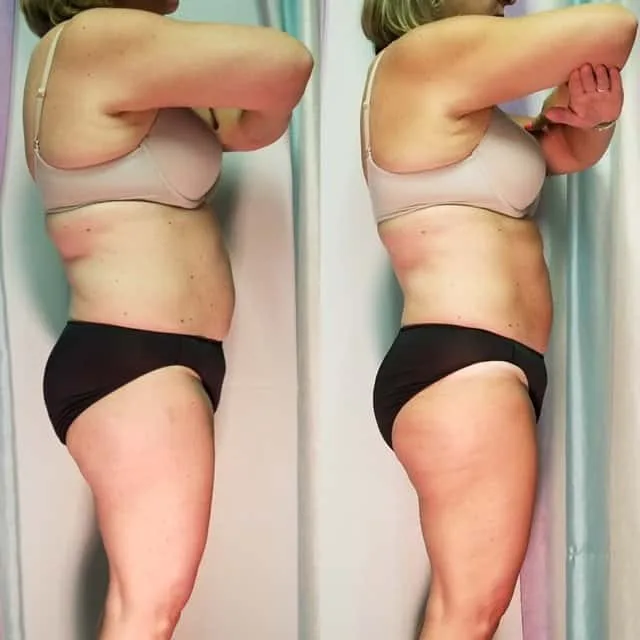 Female client body sculpting before and after, side profile showing improved posture and tone