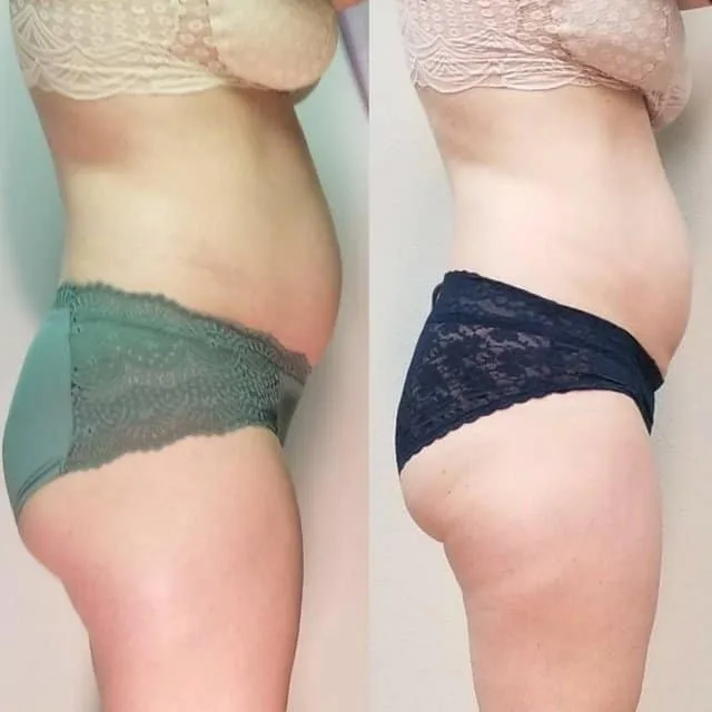 Female client body contouring before and after, side profile showing flatter abdomen