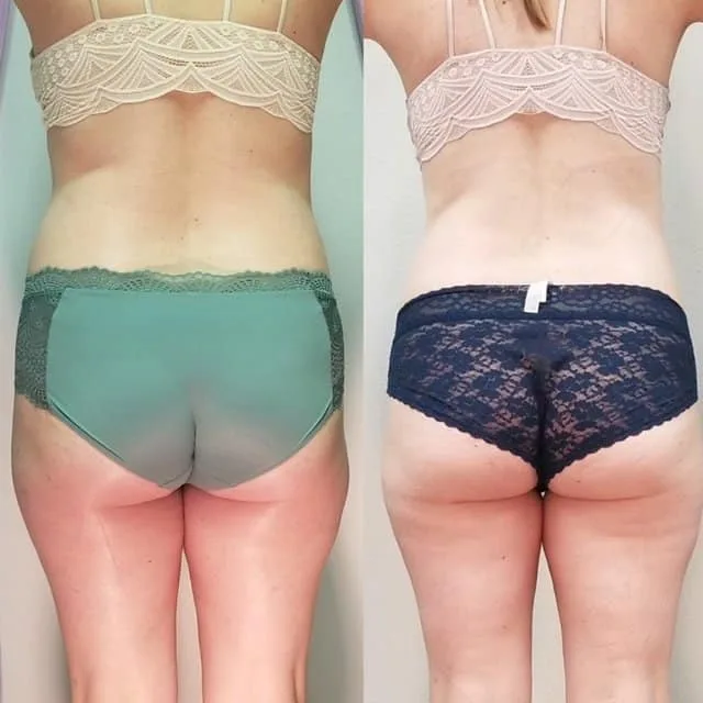Female client body contouring before and after, front view showing smoother skin and reduced cellulite