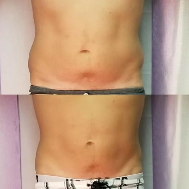 Male client body composition before and after, front view showing more defined midsection