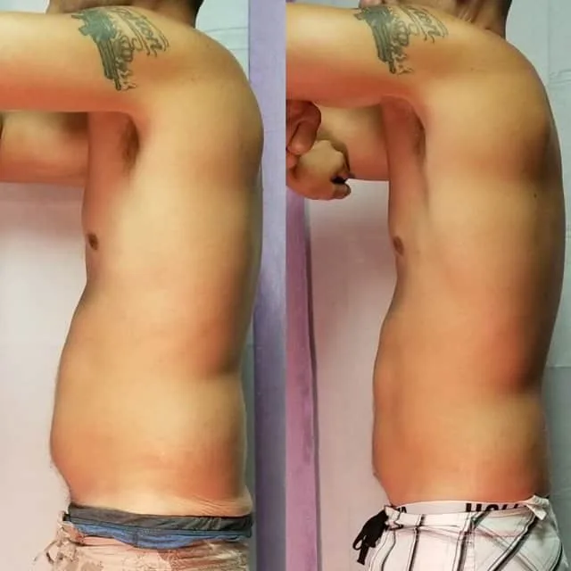 Male client body sculpting before and after, side profile showing reduced abdominal fat