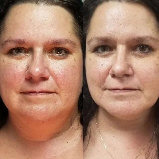 Female client face rejuvenation before and after, showing reduced puffiness and tighter jawline