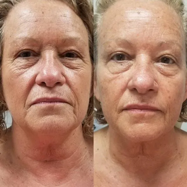 Female client face tightening before and after, showing smoother skin and reduced wrinkles