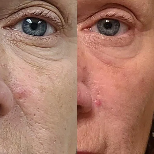 Client eye area rejuvenation before and after, showing smoother skin texture around eye