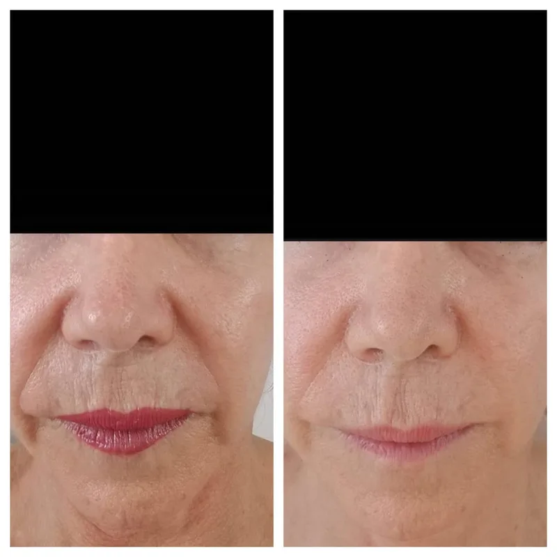 Face tightening results after 8 red light therapy sessions, showing visibly tighter skin