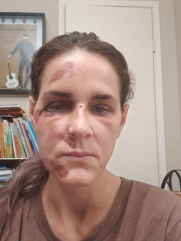 Day 1: Severe facial trauma with bruising and abrasions