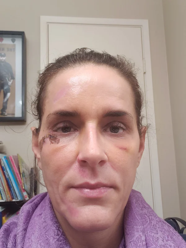 Day 5: Early healing with reduced swelling