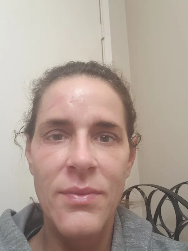 Day 23: Significant healing with minimal scarring