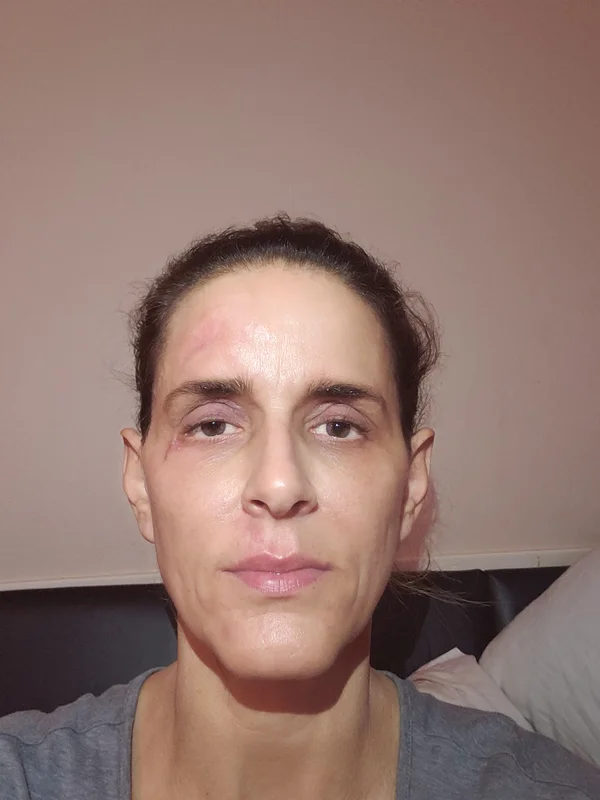 Day 28: Near-complete recovery with minimal visible scarring