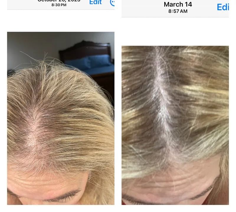 Female client hair regrowth before and after, showing significantly fuller hair volume